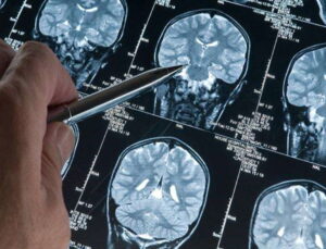 Erken teşhiste yeni adım: Alzheimer’da ‘kan testi’ dönemi