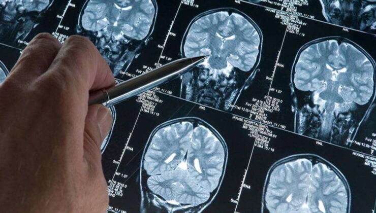 Erken teşhiste yeni adım: Alzheimer’da ‘kan testi’ dönemi