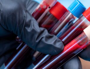 Tek tüp kanla Alzheimer teşhisi: Erken tanı artık mümkün